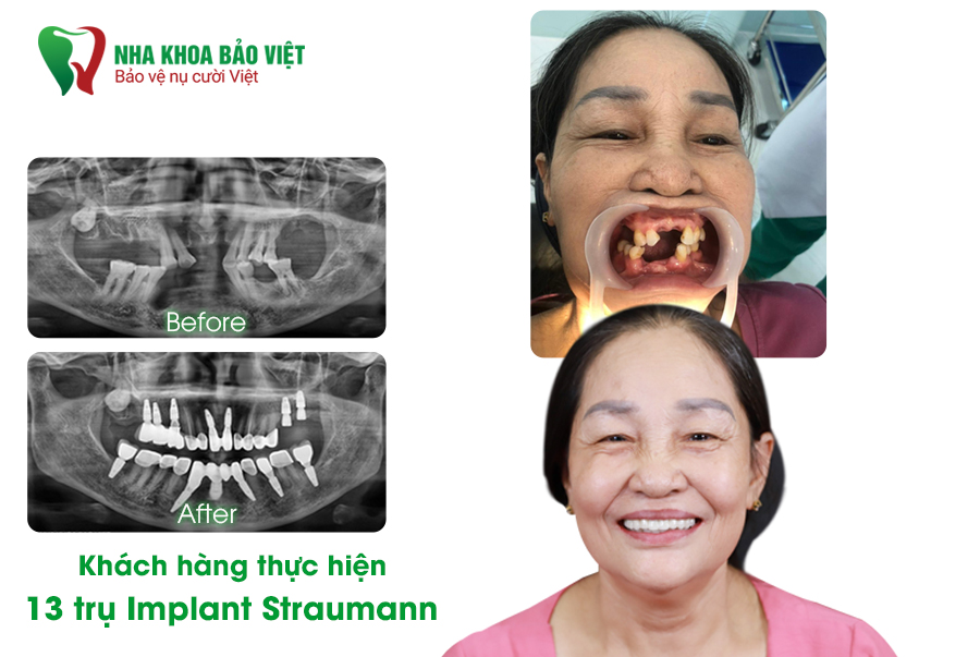 Khách hàng Nha khoa Bảo Việt sau khi trồng răng Implant