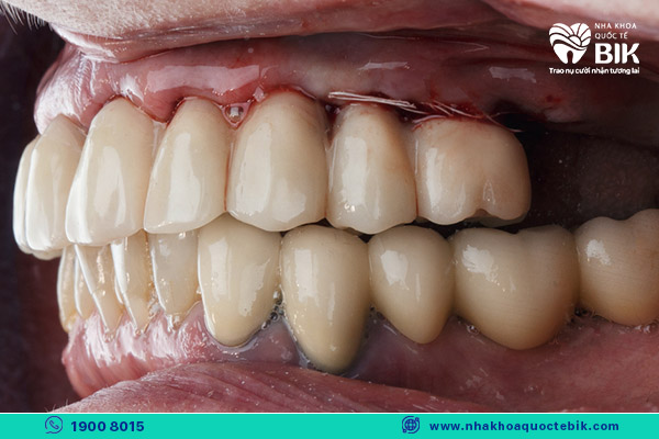 không chăm sóc răng miệng dẫn đến tác hại khi bọc răng sứ