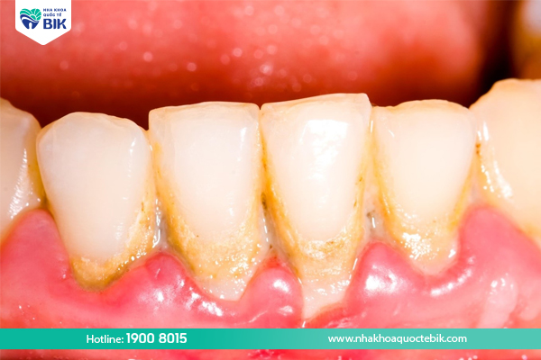Vệ sinh răng miệng kém - Nguyên nhân chảy máu chân răng