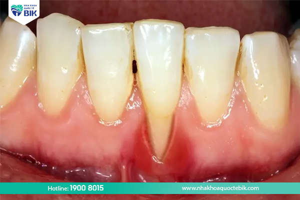 Viêm chân răng có mủ là gì?